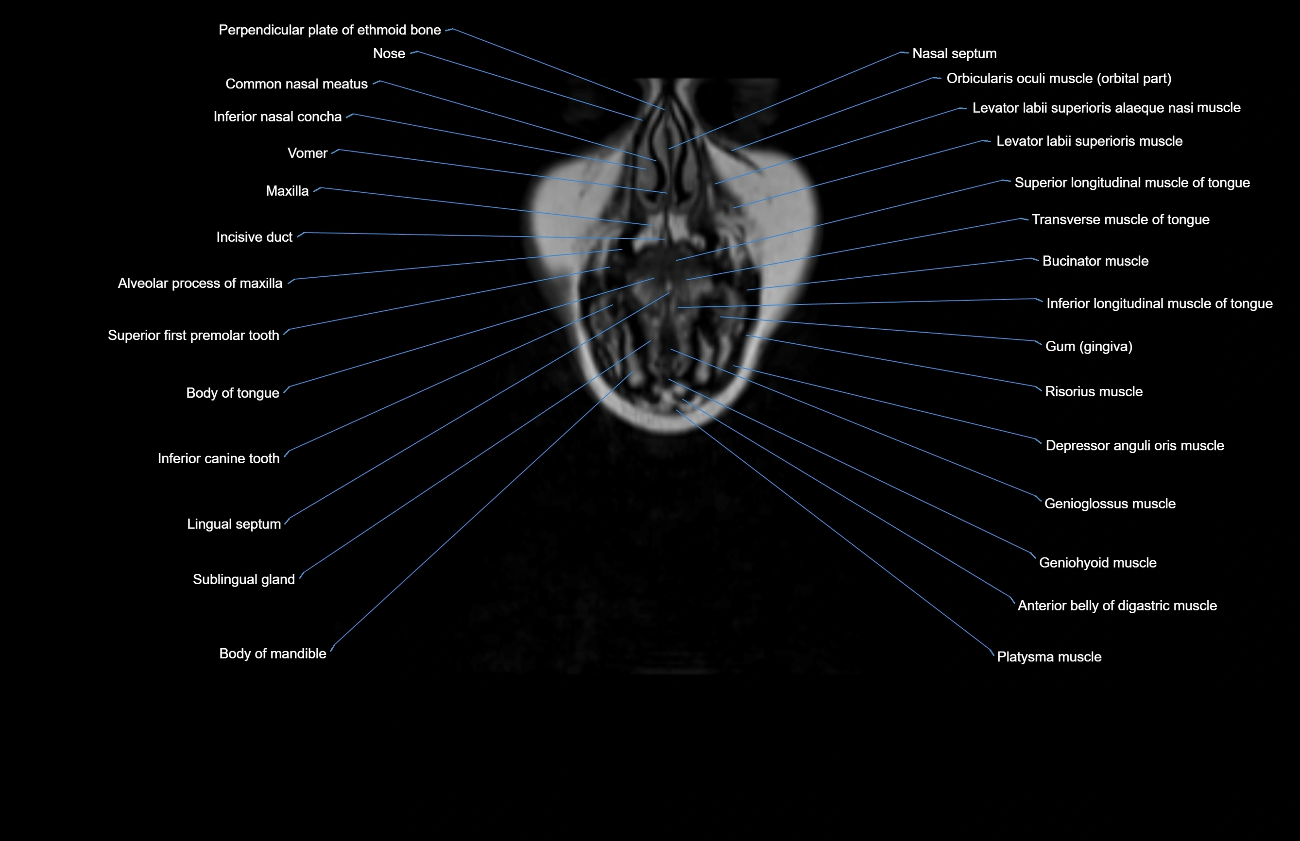 Neck coronal cross sectional MRI anatomy 3T MRI  image-img-00001-00072.webp